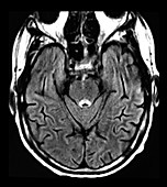 Wernicke's Encephalopathy on MRI