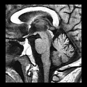 Wernicke's Encephalopathy on MRI