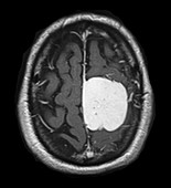 Parafalcine Meningioma MRI