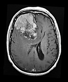MRI of Invasive Meningioma