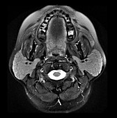 Normal MRI Parotid Glands