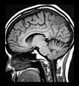 Mesial Parietal Meningioma MRI