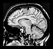 Vertex Meningioma MRI