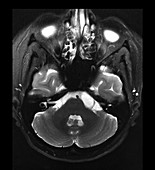 Epidermoid Tumour on MRI