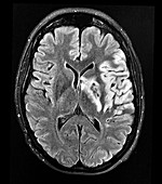 Haemorrhagic MCA Infarct MRI