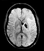 Haemorrhagic MCA Infarct MRI