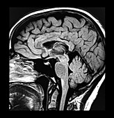 Multiple Sclerosis MRI