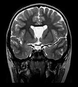MRI Cavum Septum Pellucidum et Vergae