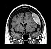 MRI Subdural Hematoma