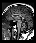 MRI Cerebellar Atrophy