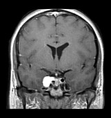 Lymphoma Cavernous Sinus MRI