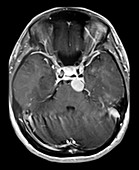 Pre-pontine Meningioma MRI