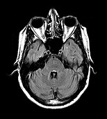 Multiple Sclerosis on MRI