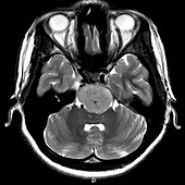 Clival Meningioma on MRI