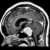 Clival Meningioma on MRI