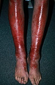 Eczema Secondary Infection