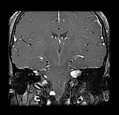 MRI Neurofibromatosis Type 2 (MISME) 6