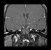 MRI Neurofibromatosis Type 2 (MISME) 4