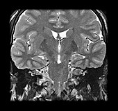 MRI Neurofibromatosis Type 2 (MISME) 2