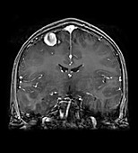 MRI of Arterial Venous Fistulas 5