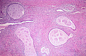 Myometrial carcinoma, uterus, LM