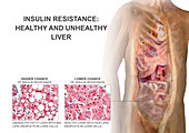 Insulin Resistance, Healthy Vs. Fatty Liver