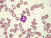 Hypersegmented neutrophils, LM