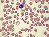 Homozygous haemoglobin E, LM