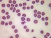 Congenital spherocytosis, LM
