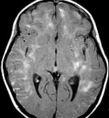 MRI of ADEM