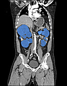 Enhanced Polycystic Kidney Disease on CT