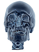 Enhanced 3D CT of Lefort Facial Fractures