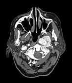 CT of Large Glomus tumour of Neck