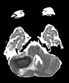 Cerebellar Abscess Secondary to Mastoiditis