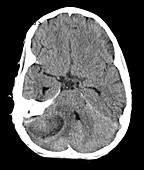 Cerebellar Abscess Secondary to Mastoiditis