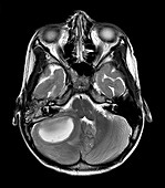 Cerebellar Abscess Secondary to Mastoiditis