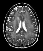 HIV Encephalitis on MRI