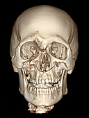 3D CT of Lefort Facial Fractures