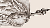 Smellie Forceps, before 1750