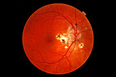 Presumed Ocular Histoplasmosis Syndrome