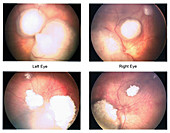 Retinoblastoma Scan Before and After Chemotherapy