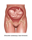 Fetus in Shoulder Position, Illustration