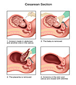 Diagram of a Cesarean Section