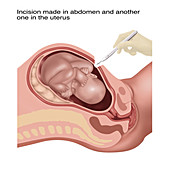 Cesarean Section Steps, Illustration, 1 of 4