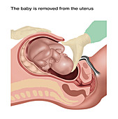 Cesarean Section Steps, Illustration, 2 of 4