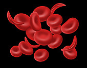 Sickle Cells, Illustration