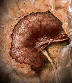 Stage 5 Kidney Disease