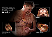 Cardiovascular Problems of Obesity