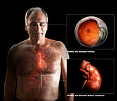 Capillary Damage from Diabetes