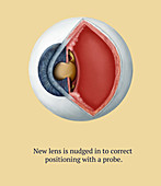 Cataract Surgery, 5 of 6, Illustration